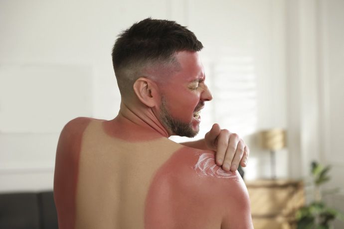 Hombre con adicción al sol sufre quemaduras de piel