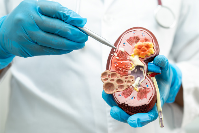 Médico explica nefropatía diabética