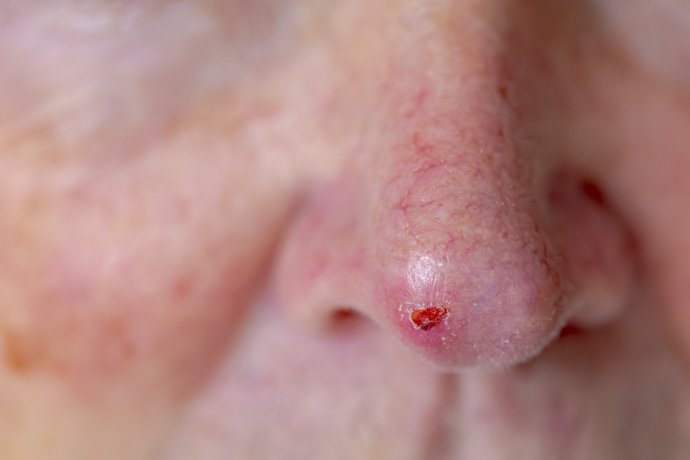 Hombre con carcinoma basal