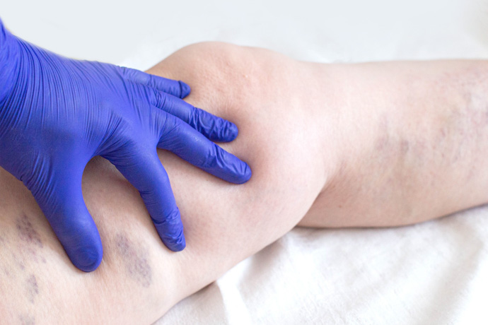 Ejemplo de tratamiento para la insuficiencia venosa.