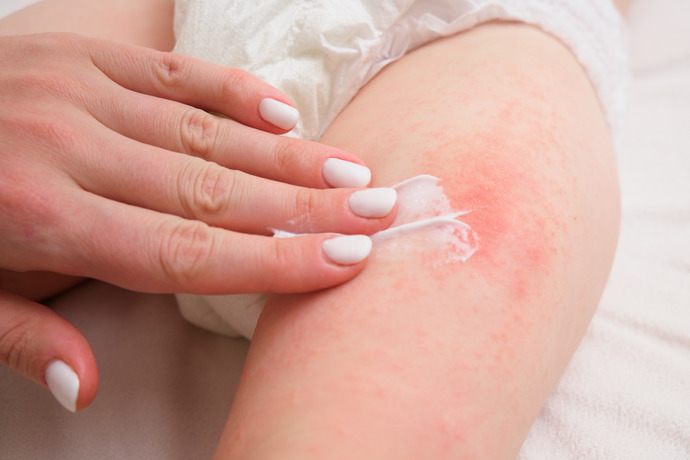 Mujer aplica crema para el tratamiento de la dermatitis atópica