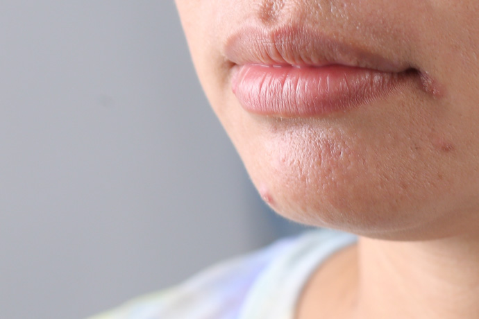 mujer en consulta médica por boqueras