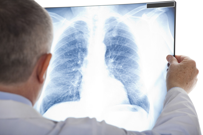 Médico evalúa pulmones por principio de pulmonía