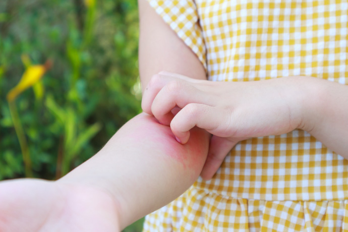 Niña rascándose el brazo por un sarpullido sin fiebre.
