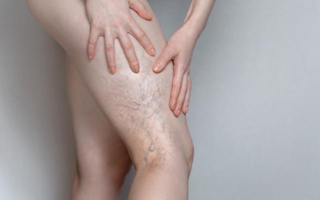 Persona que sufre de insuficiencia venosa. 