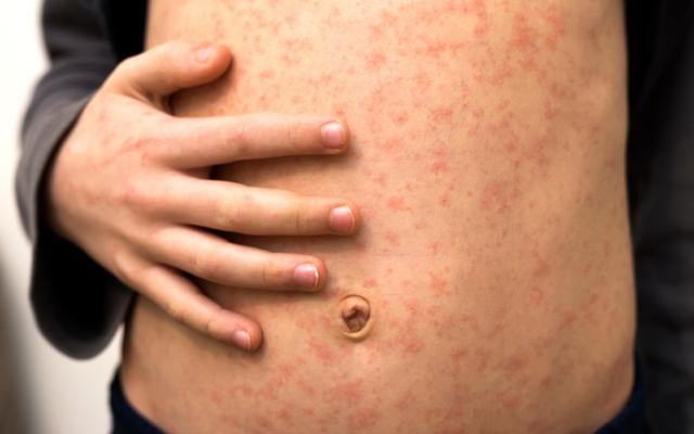 Ejemplo de sarpullido en un niño sin fiebre.