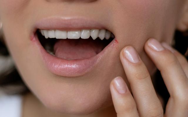 mujer con síntomas visibles de queilitis angular