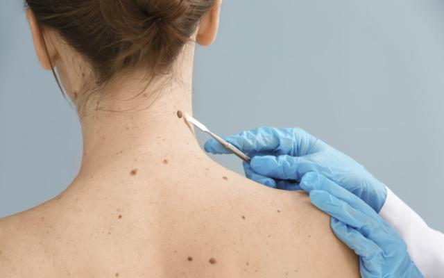 Médico evalúa quitar lunares