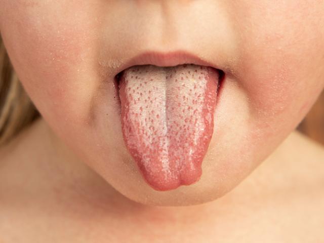 Niña con escarlatina enseñando lengua.