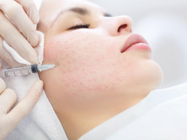 Mujer en tratamiento de mesoterapia