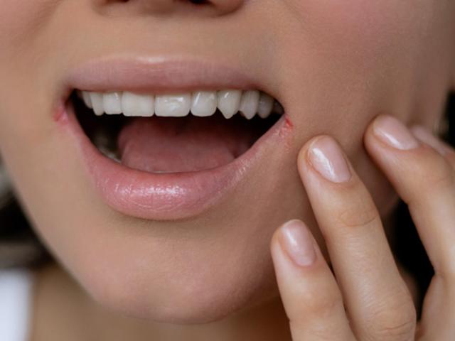 mujer con síntomas visibles de queilitis angular