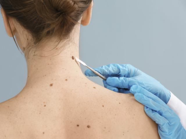 Médico evalúa quitar lunares