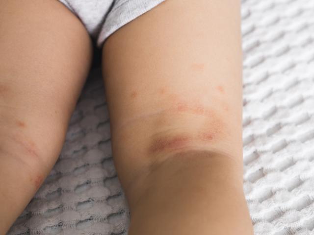 Bebé con manchas rojas en la piel